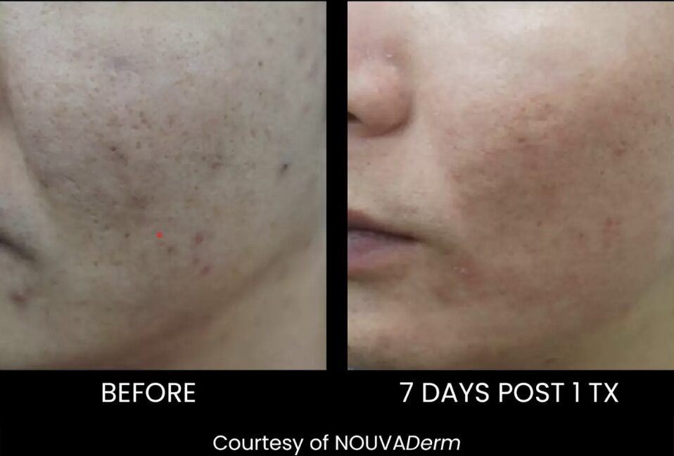 Nouvaderm for hyperpigmentation and texture